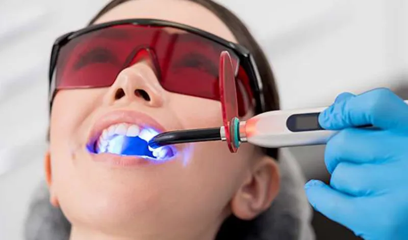 Tratamientos para blanquear tus dientes a buen precio